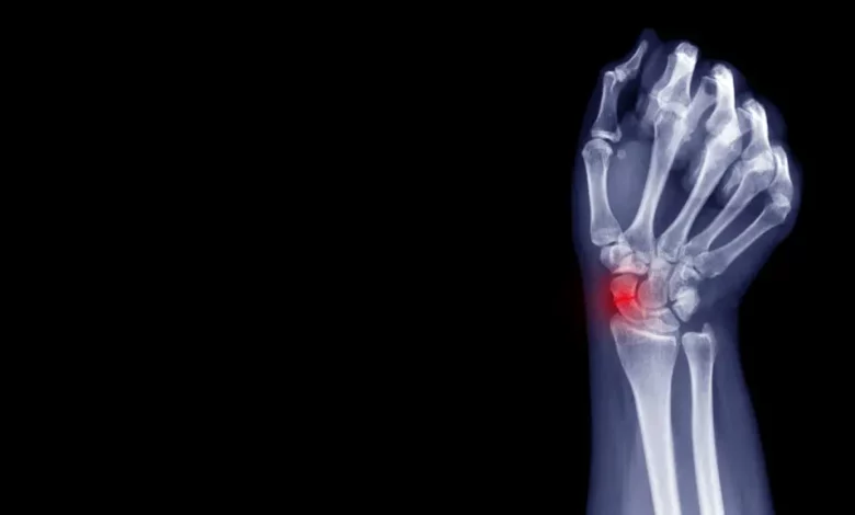 Common Types of Wrist Fractures and Effective Treatment Options