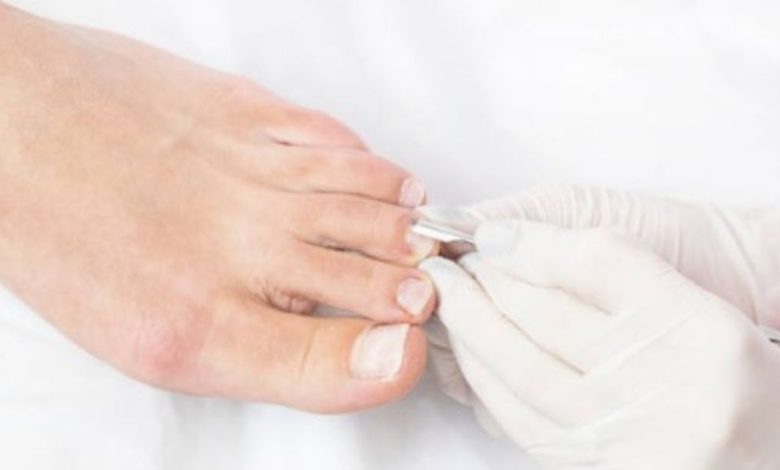 Why Choose Us For Ingrown Toenail Removal At The Doctor Kris A. Dinucci?