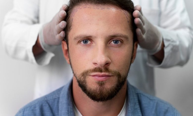 What Should I Do If I Notice Shock Loss After a Hair Transplant