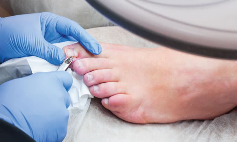 What Symptoms Indicate Progress in Toenail Removal Healing Stages